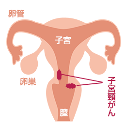 子宮頸がん
