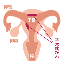 子宮体がん